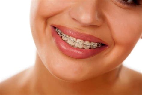 cuanto valen los brackets metalicos|precio de brackets en mexico.